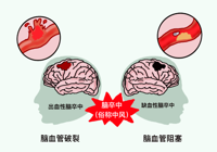 【健康科普】武宁县人民医院内二科：卒中识别早，救治效果好！